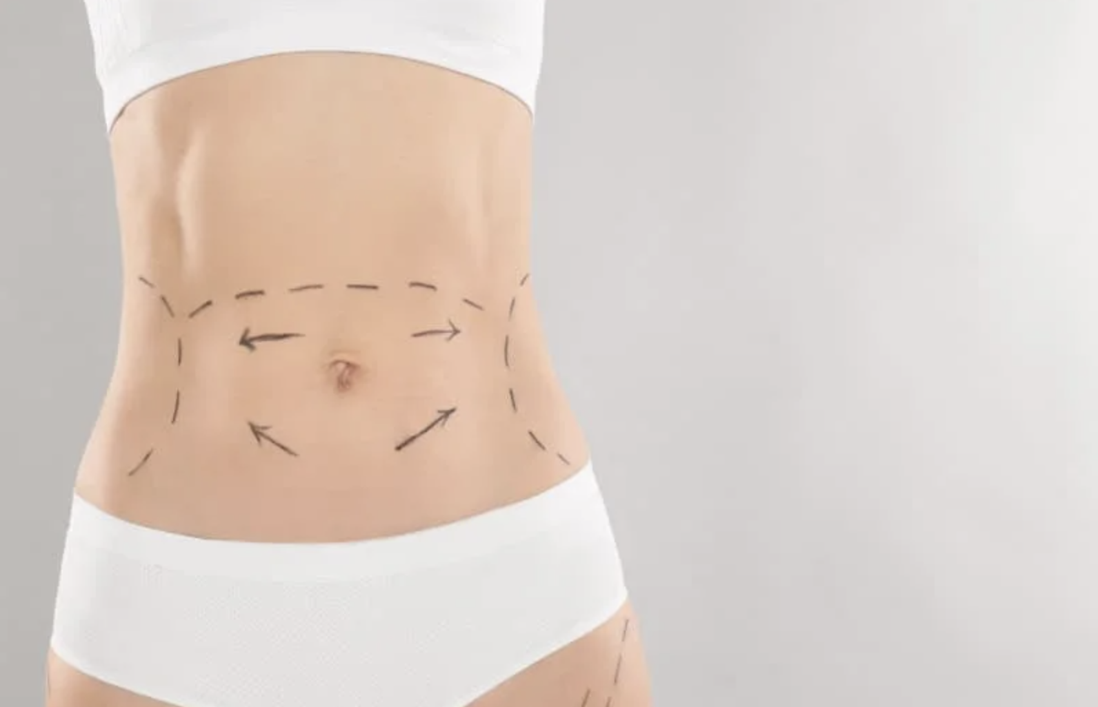 Tummy Tuck Surgery Week-By-Week Recovery Timeline