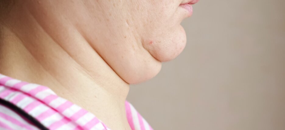 How Much Does Chin Liposuction Cost Dr Aghayan