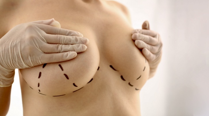BREAST REDUCTION Before And After Try On, 6 Week Post-Op