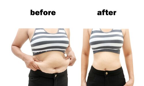 Dr. Careaga and Dr. Durand's Top Recovery Tips After Liposuction