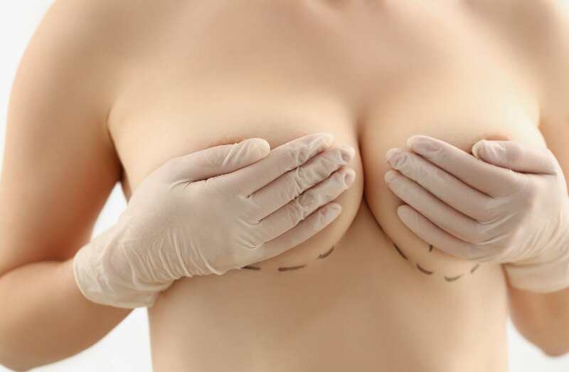 Breast Implants: 7 Things I Wish I Knew Before Getting Them