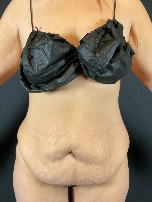 Brazilian Butt Lift Before & After Image