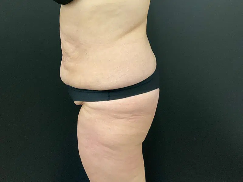 Brazilian Butt Lift Before & After Image