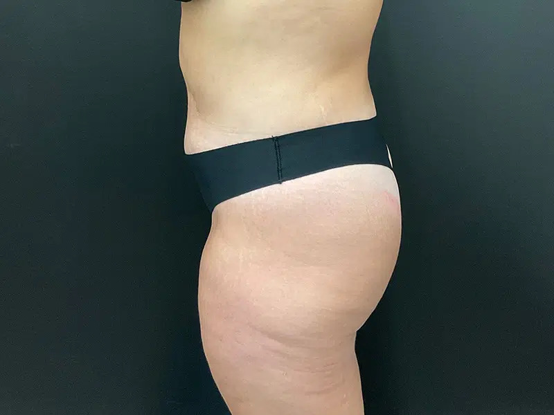 Brazilian Butt Lift Before & After Image