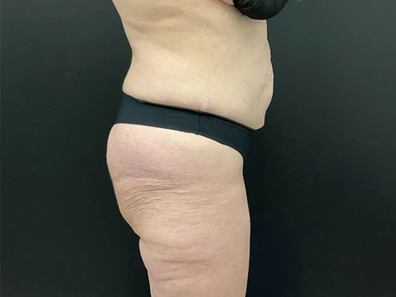 Brazilian Butt Lift Before & After Image