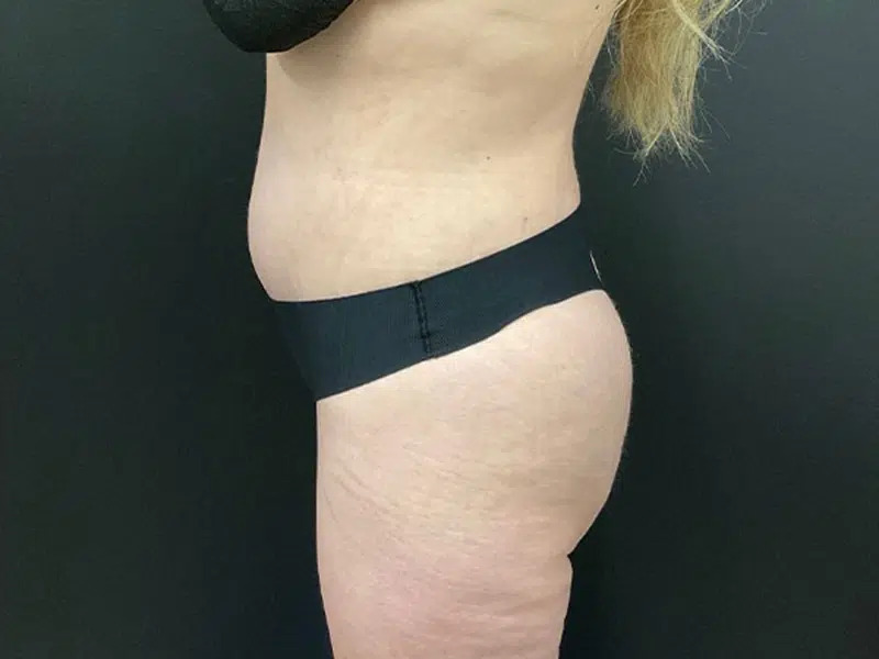 Brazilian Butt Lift Before & After Image