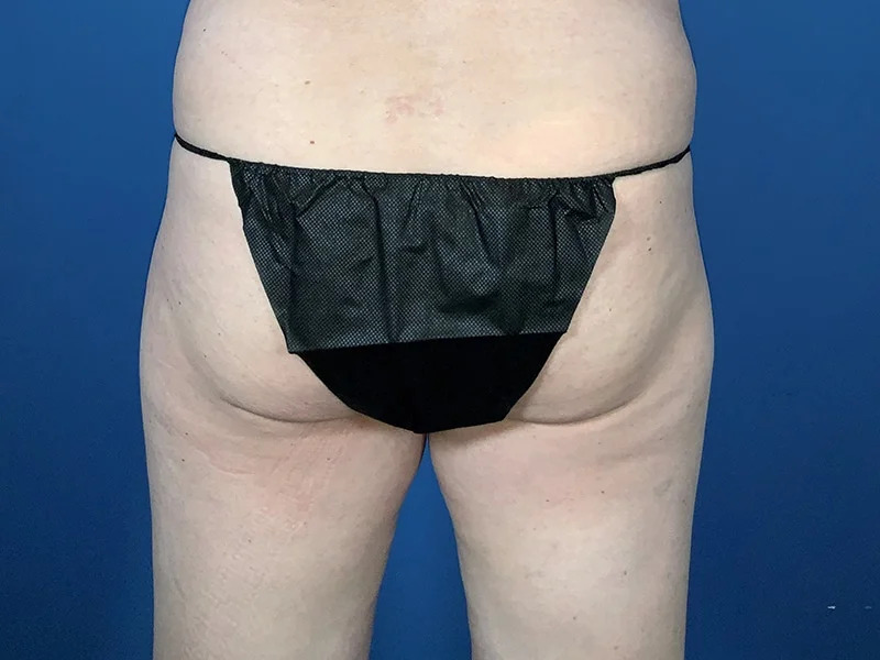 Brazilian Butt Lift Before & After Image