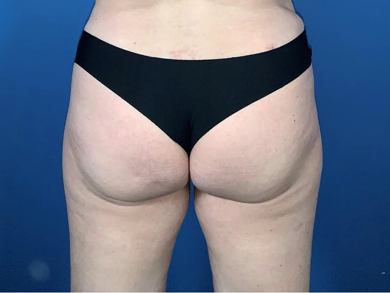 Brazilian Butt Lift Before & After Image