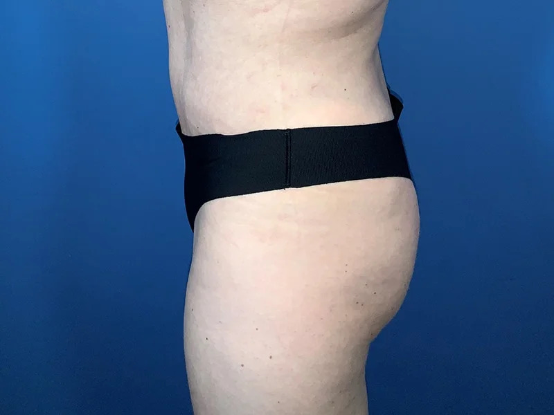 Brazilian Butt Lift Before & After Image