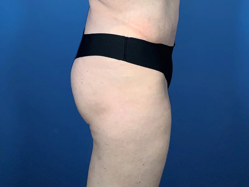 Brazilian Butt Lift Before & After Image