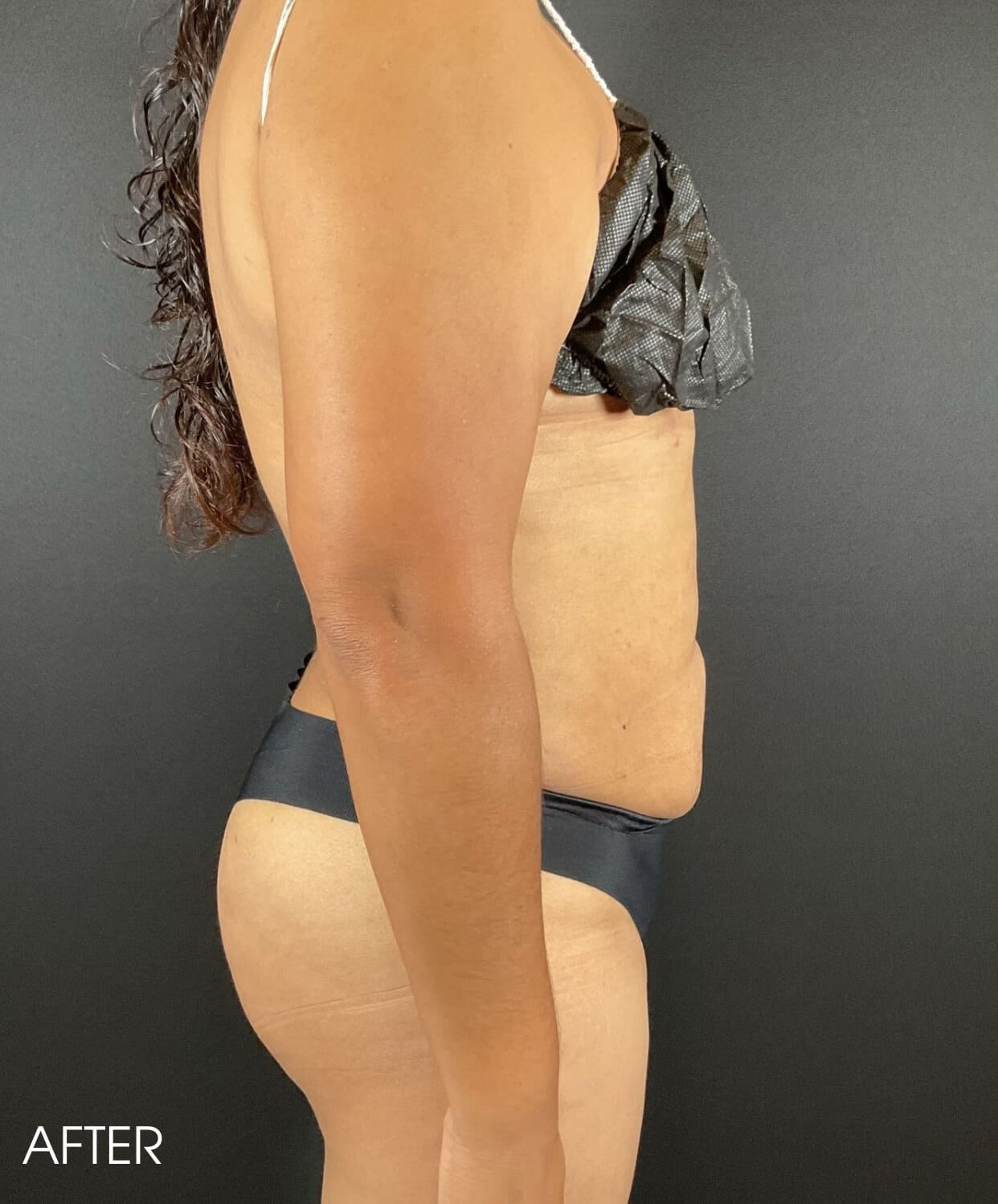 Liposuction Before & After Image