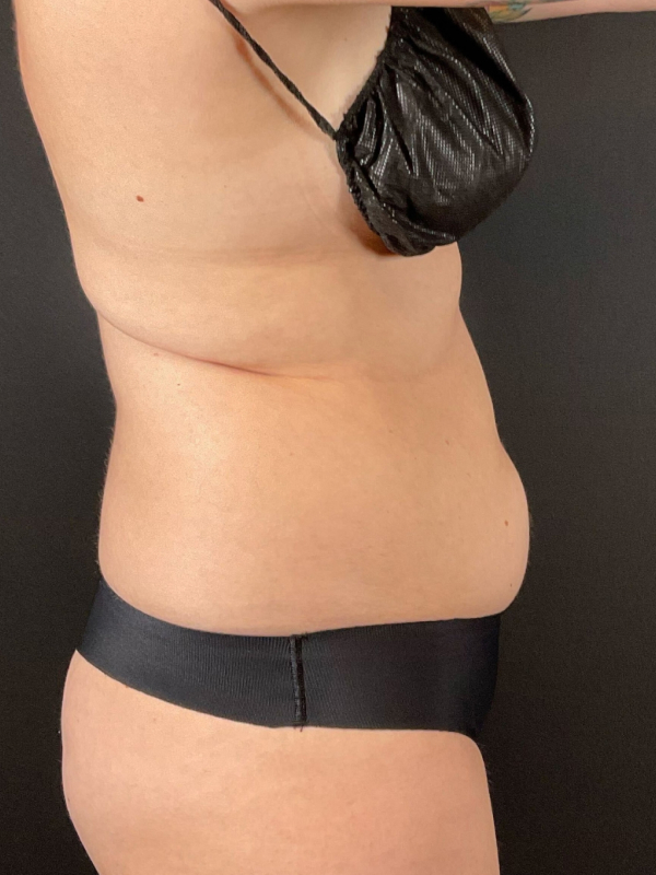 Liposuction Before & After Image