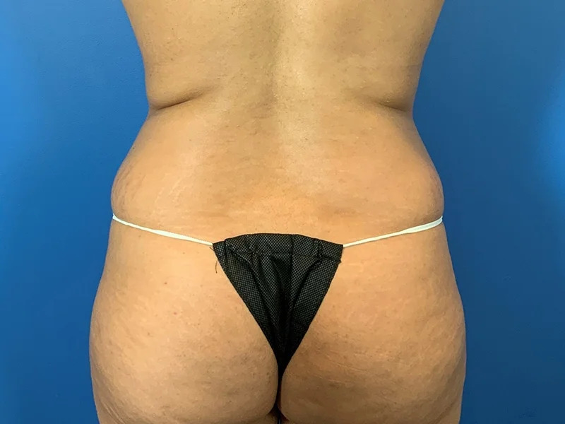 Liposuction Before & After Image