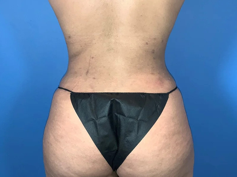 Liposuction Before & After Image