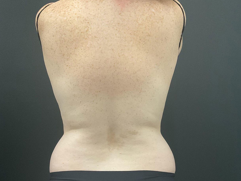 Liposuction Before & After Image