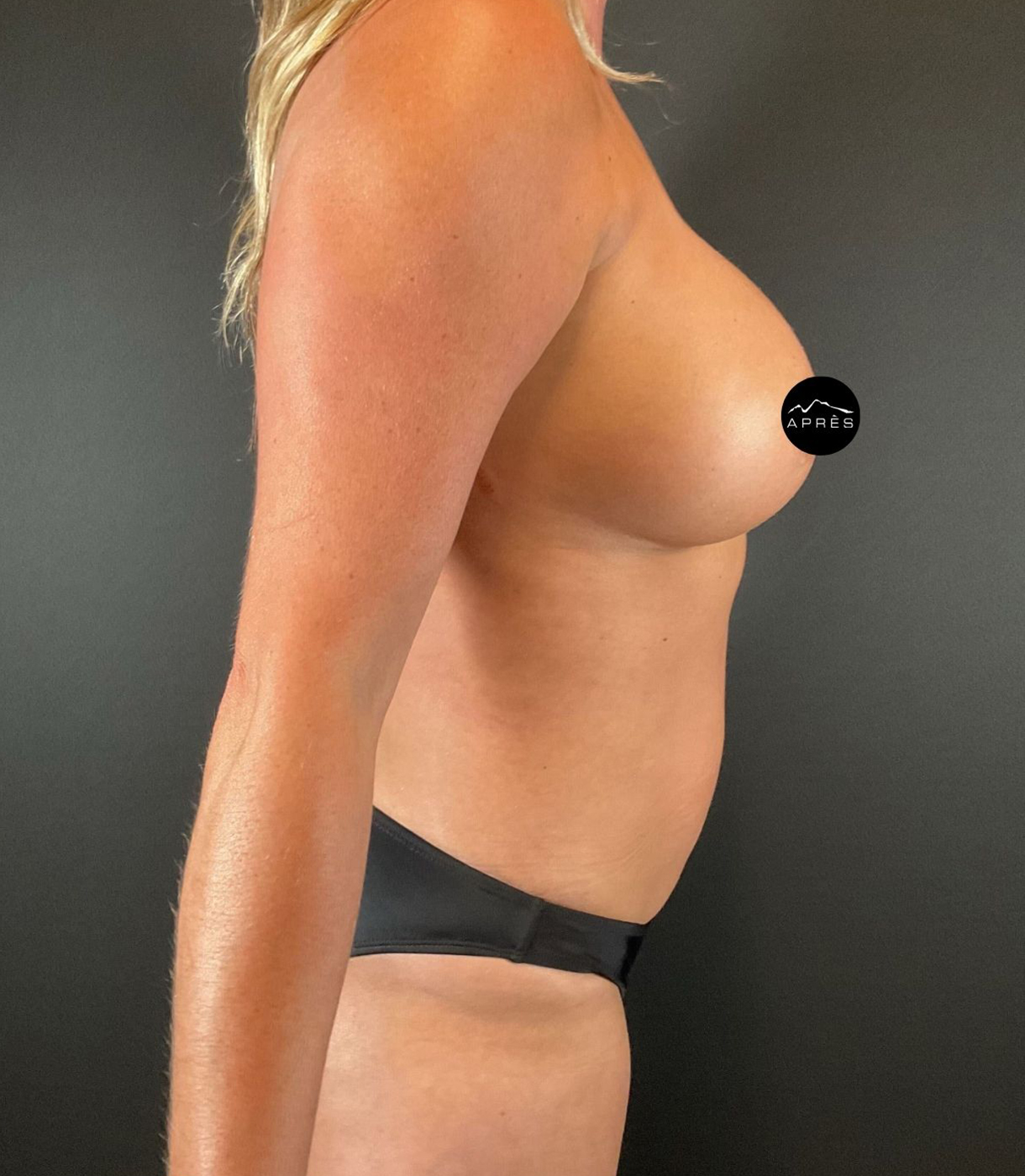 Liposuction Before & After Image