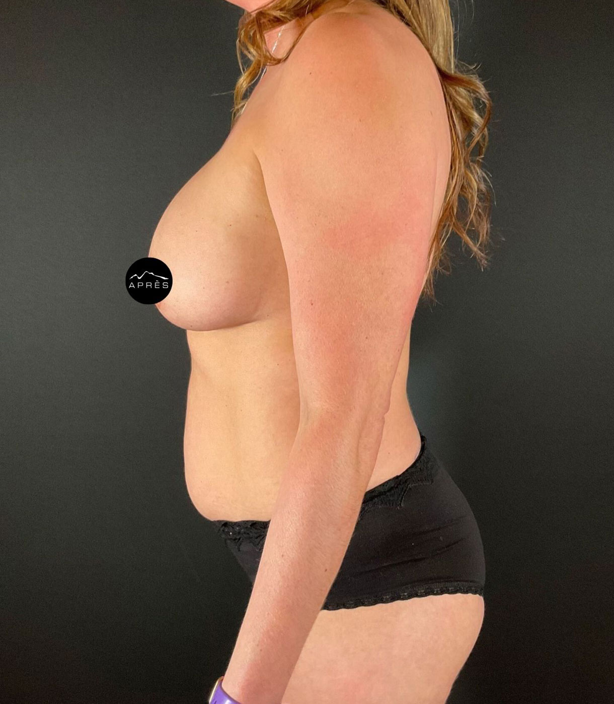 Liposuction Before & After Image