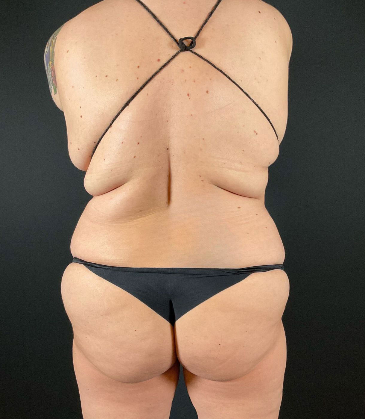 Liposuction Before & After Image