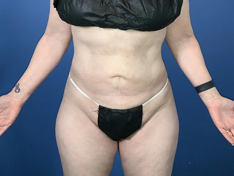 Liposuction Before & After Image