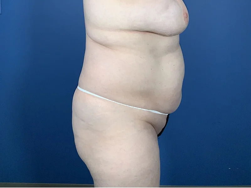 Liposuction Before & After Image