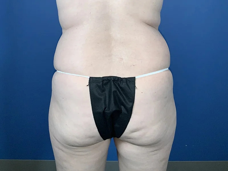 Liposuction Before & After Image