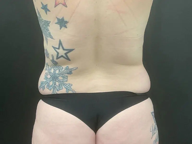 Liposuction Before & After Image