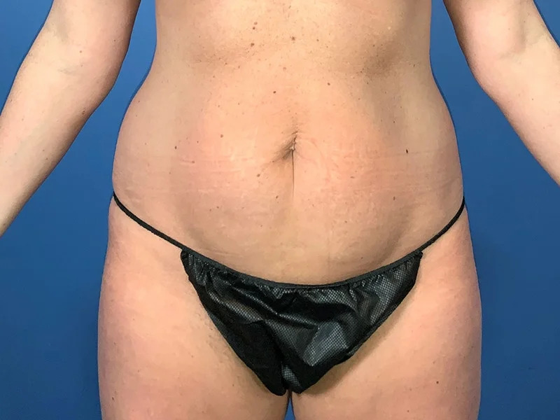 Liposuction Before & After Image