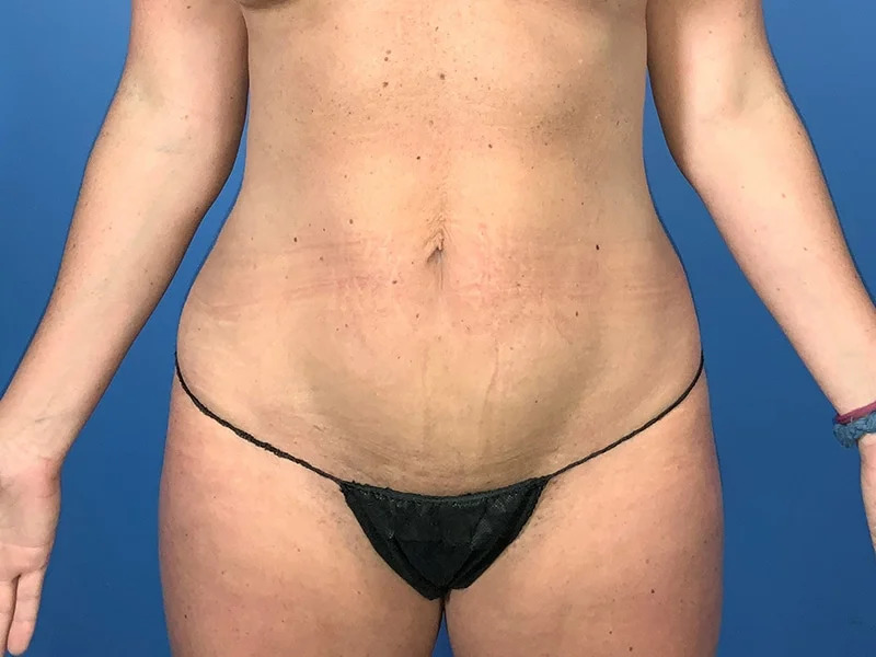 Liposuction Before & After Image