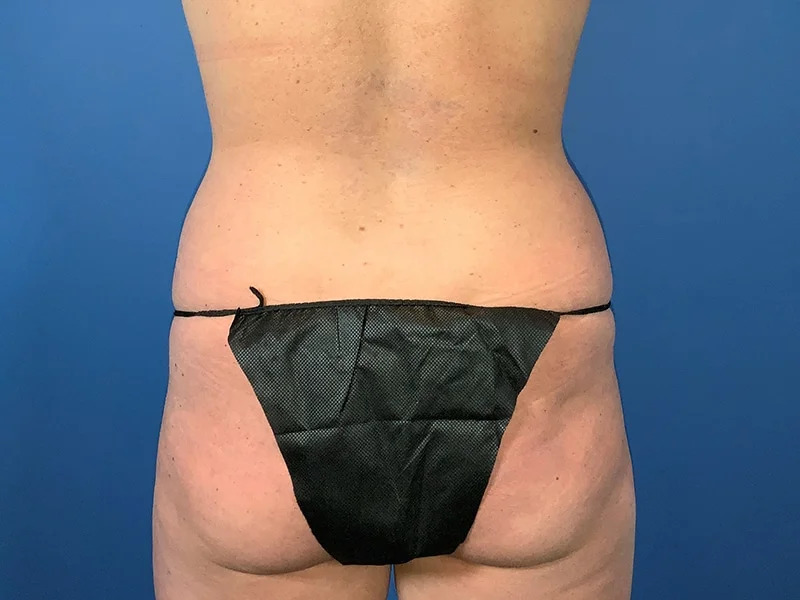 Liposuction Before & After Image