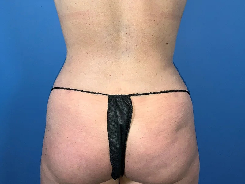 Liposuction Before & After Image