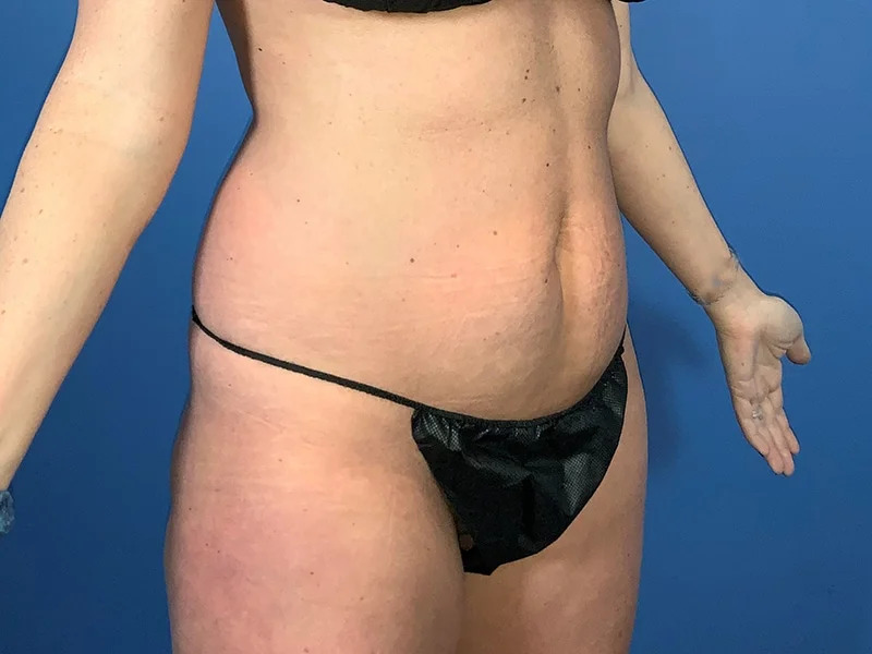 Liposuction Before & After Image