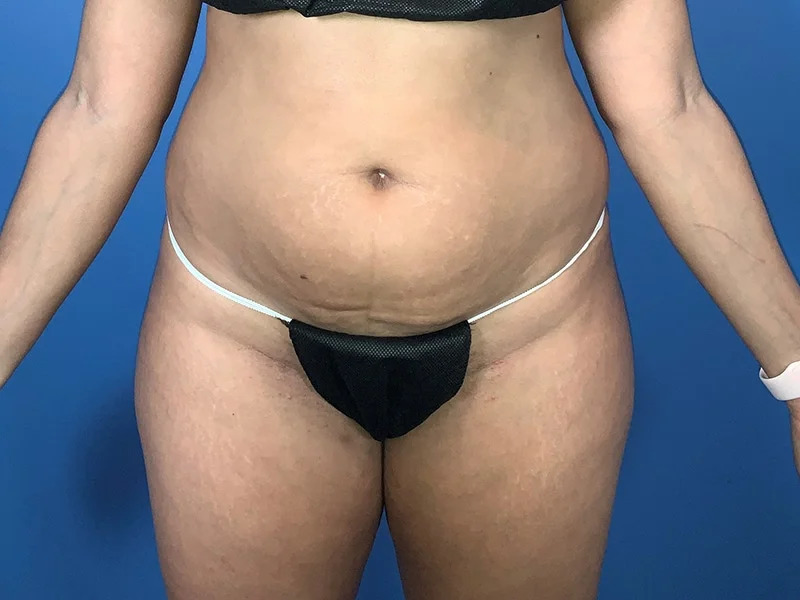 Liposuction Before & After Image