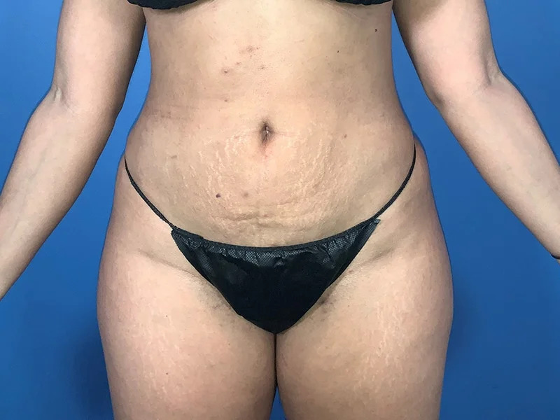 Liposuction Before & After Image