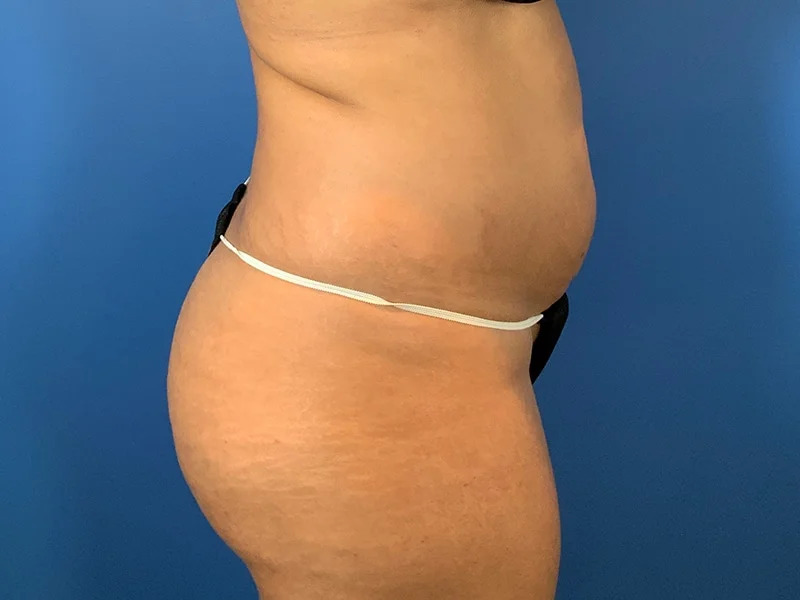 Liposuction Before & After Image