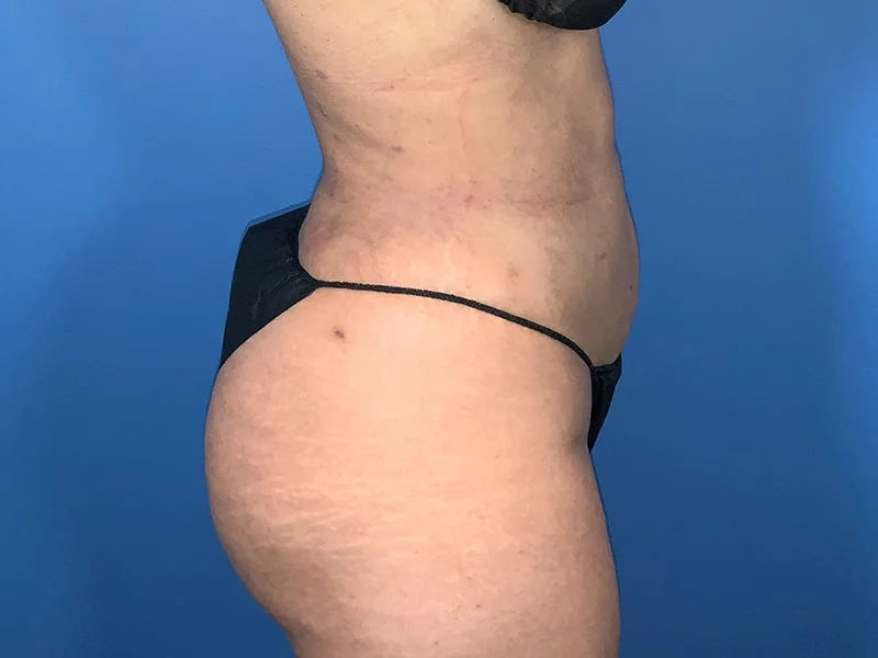 Liposuction Before & After Image