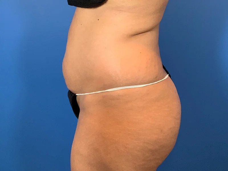 Liposuction Before & After Image