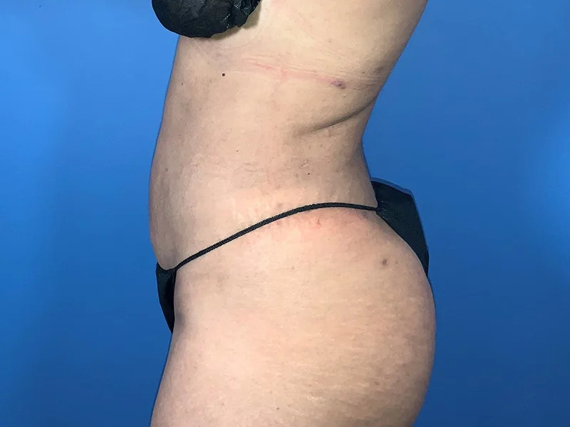 Liposuction Before & After Image