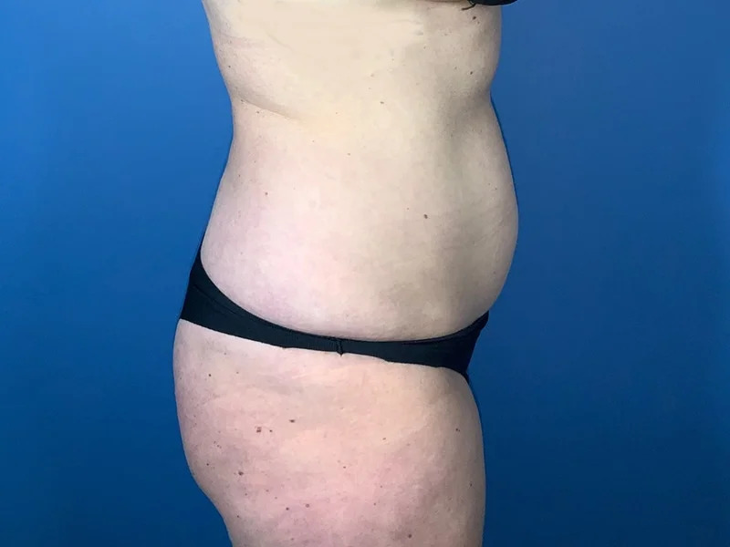 Liposuction Before & After Image