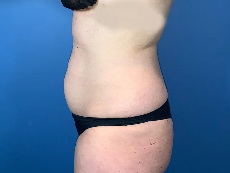 Liposuction Before & After Image