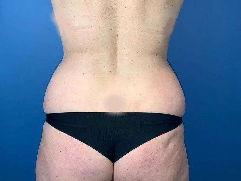 Liposuction Before & After Image