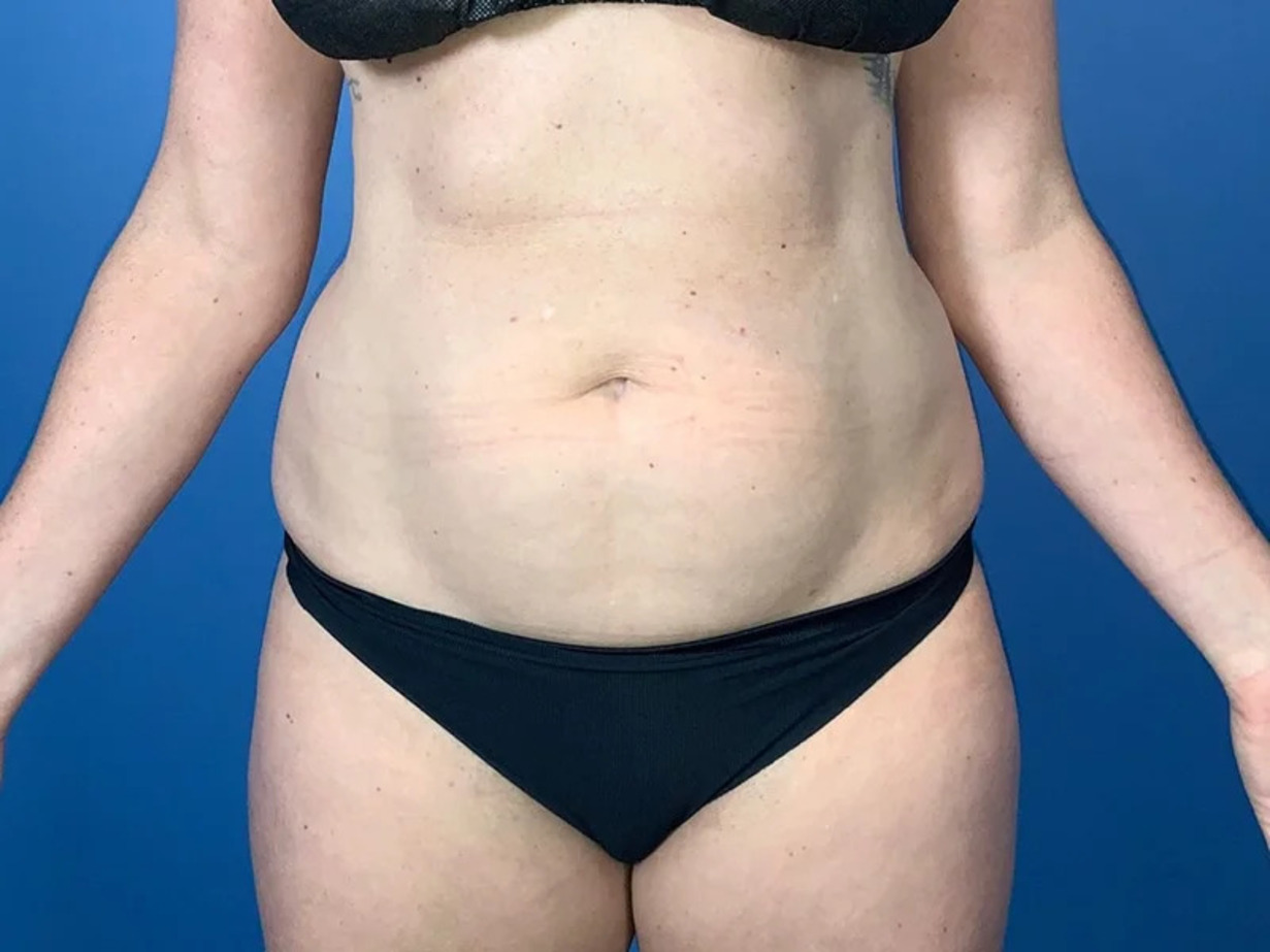 Liposuction Before & After Image