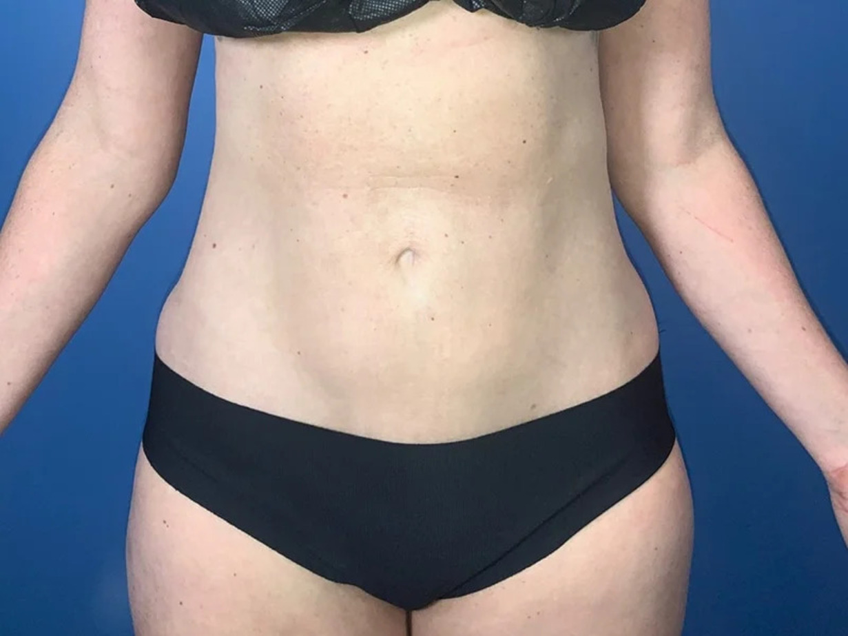 Liposuction Before & After Image