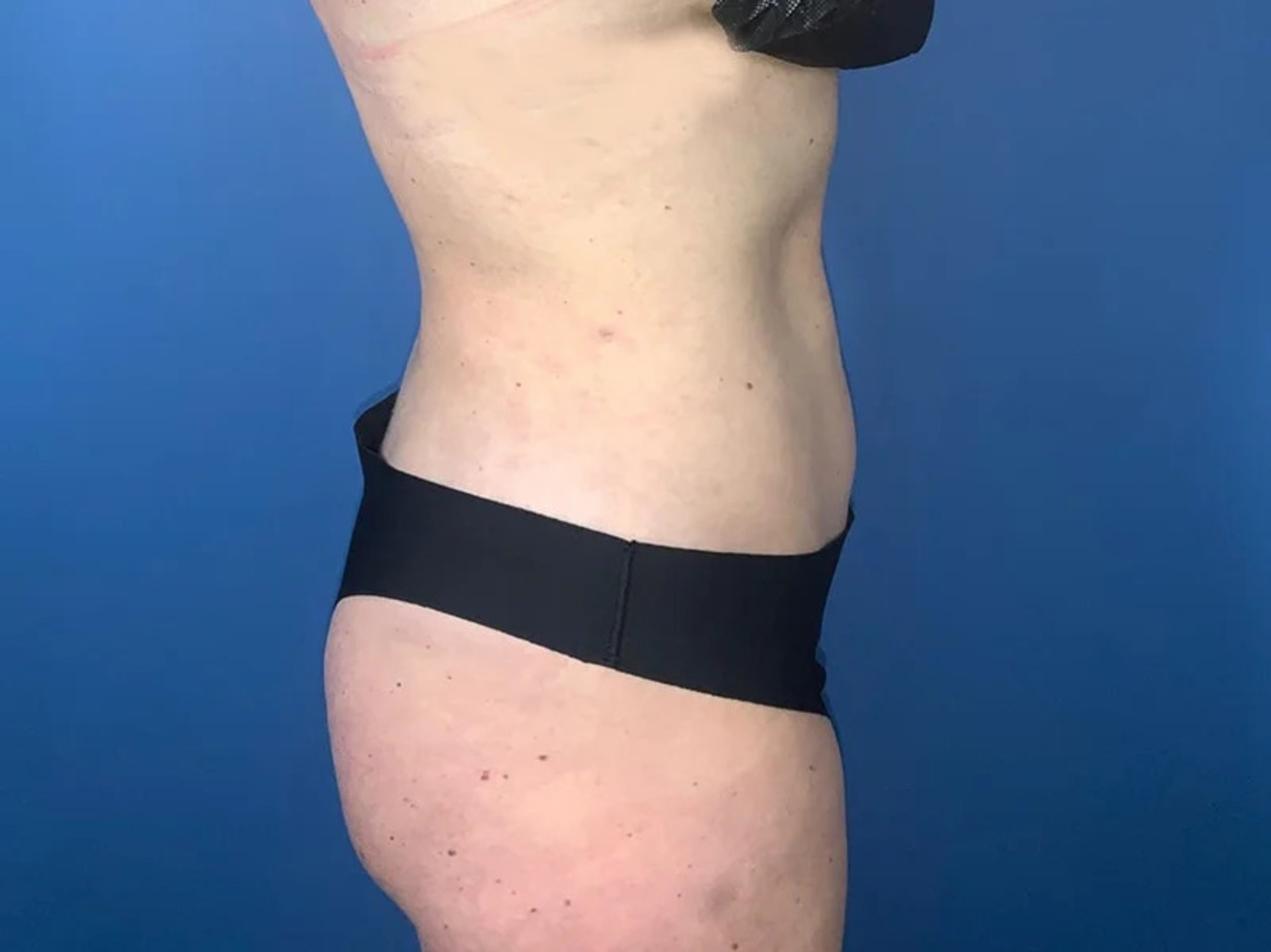 Liposuction Before & After Image