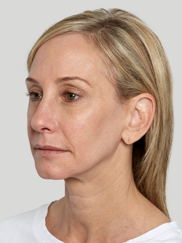 Sculptra Before & After Image