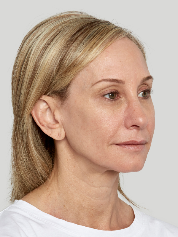 Sculptra Before & After Image