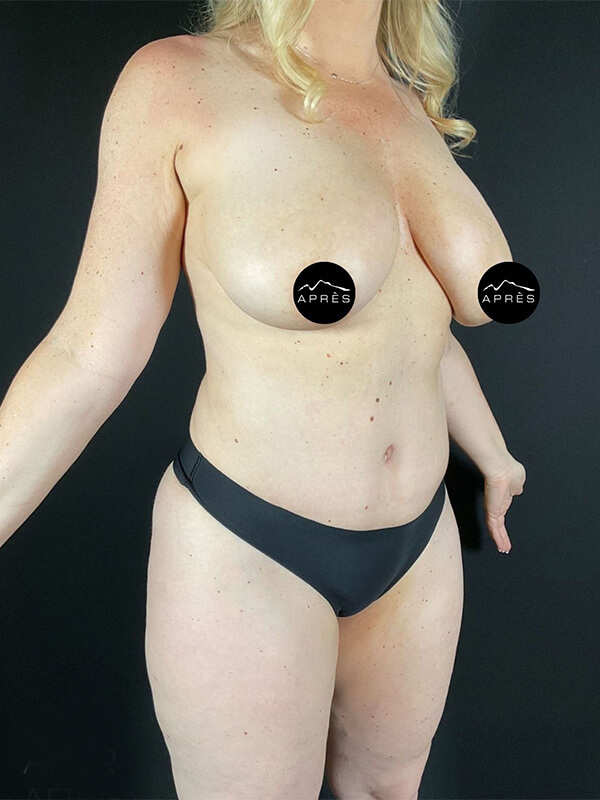 Tummy Tuck Before & After Image