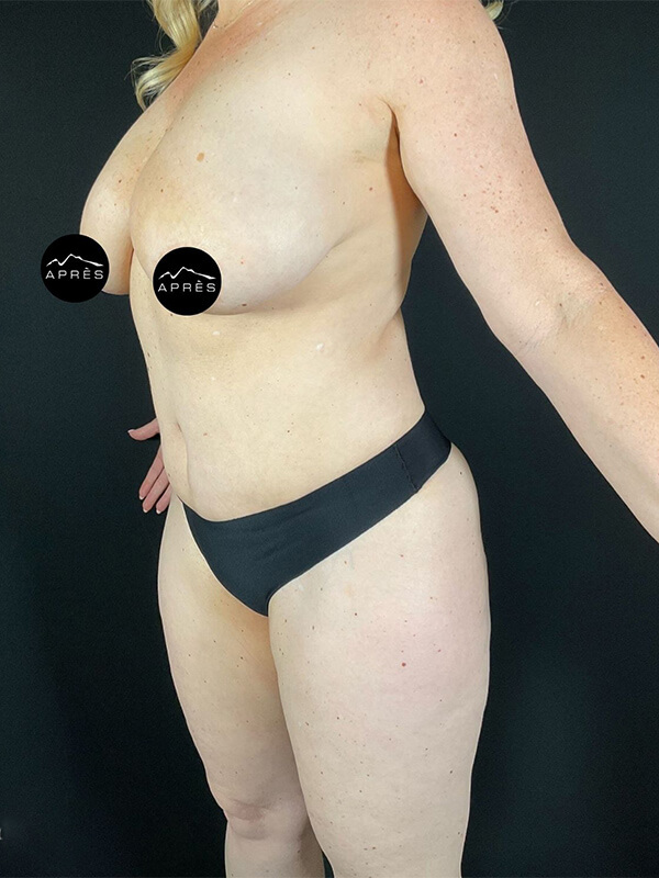 Tummy Tuck Before & After Image