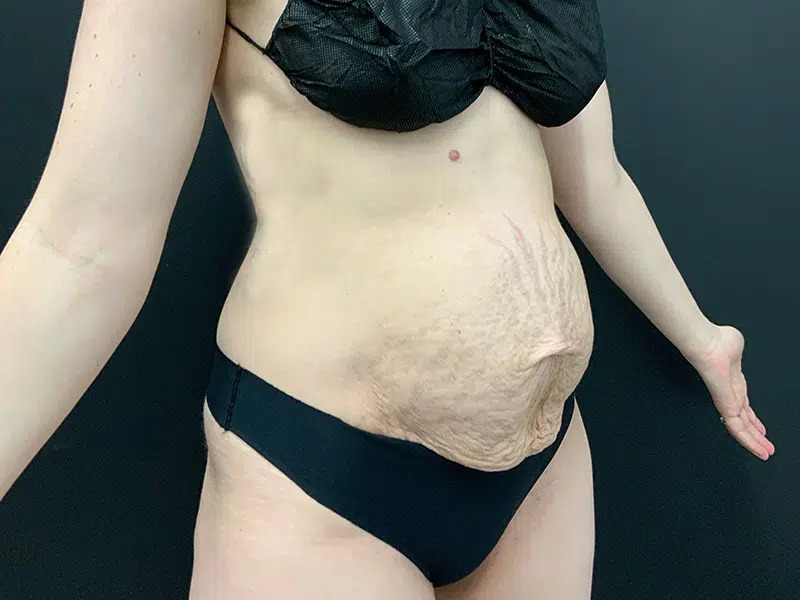 Tummy Tuck Before & After Image