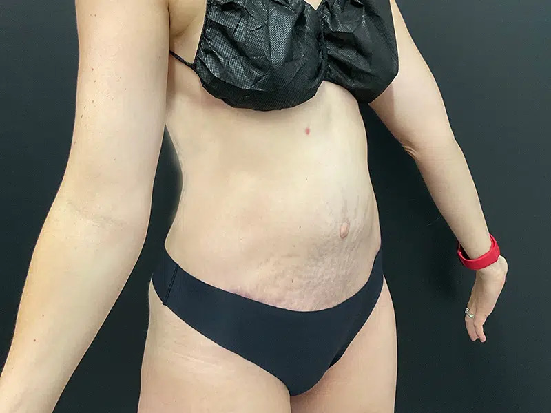 Tummy Tuck Before & After Image