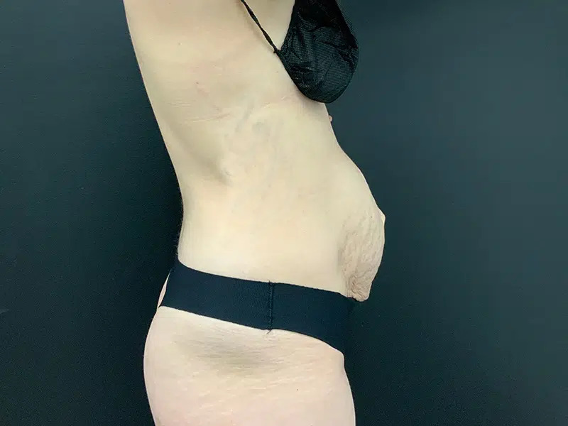 Tummy Tuck Before & After Image